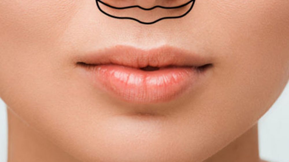 liplifting