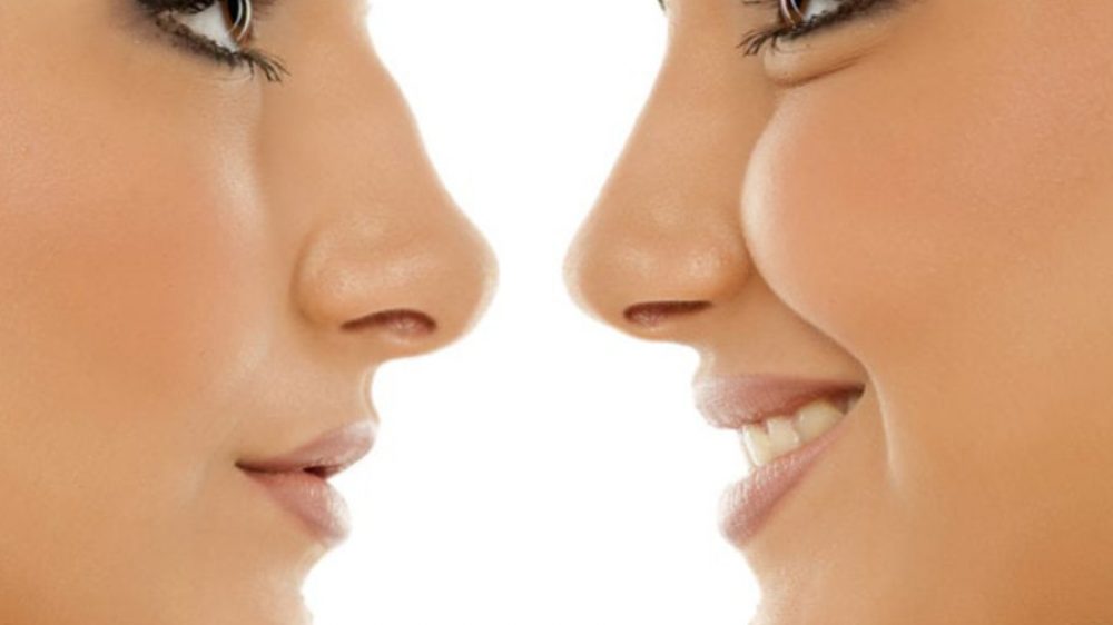 rhinoplasty